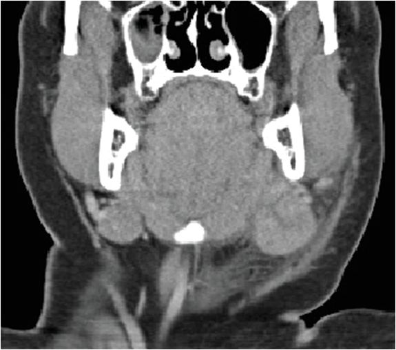 41 48yearold male with recurrent left facial swelling