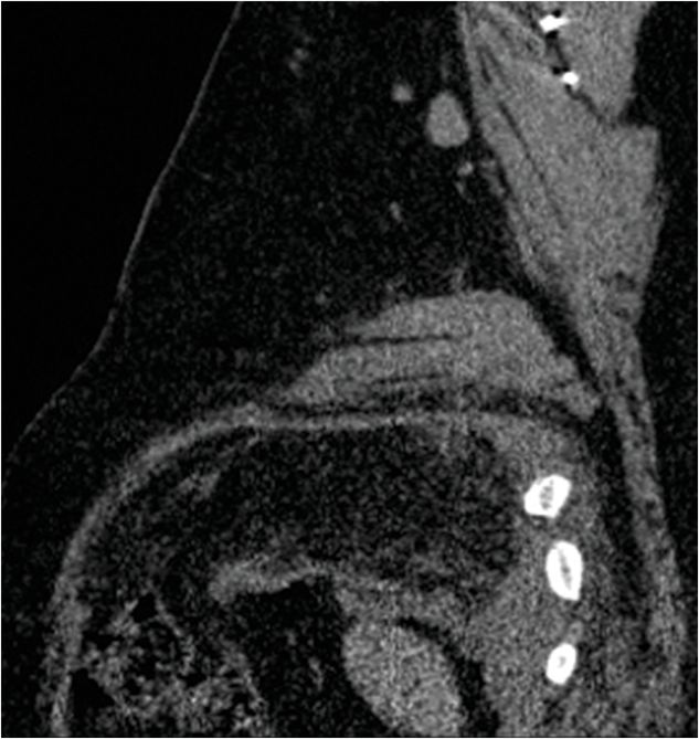 59 45yearold male presenting with left upper quadrant pain and