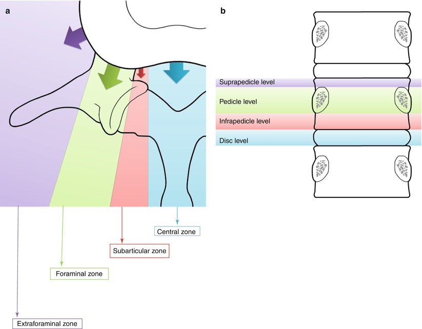 Common Spine Disorders Associated with Back Pain Radiology Key