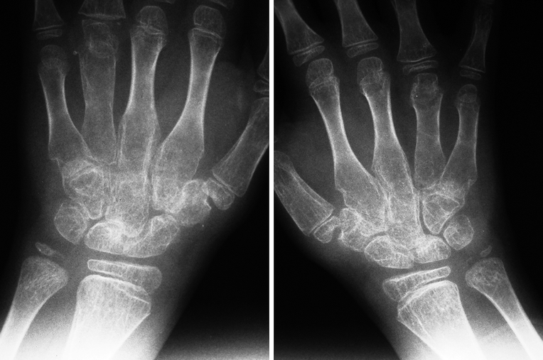 Juvenile Idiopathic Arthritis Radiology Key