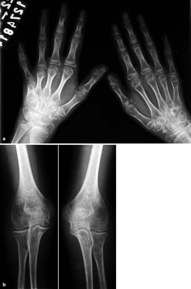 Juvenile Idiopathic Arthritis Radiology Key