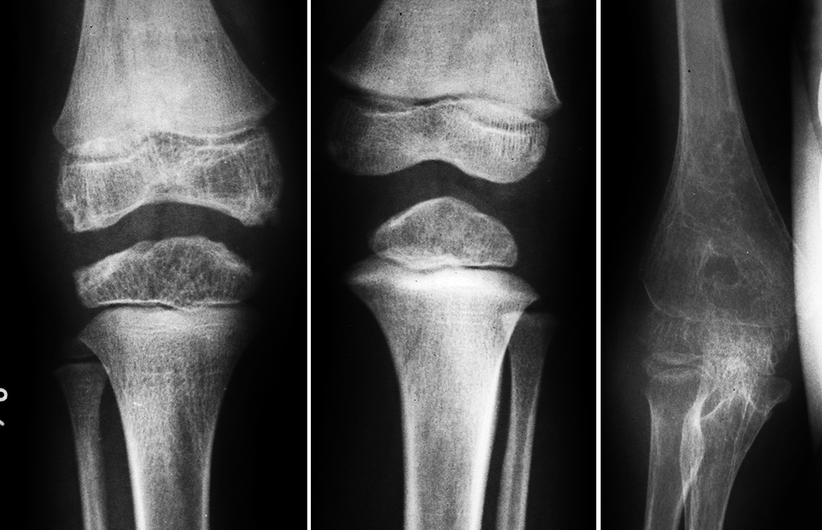 Juvenile Idiopathic Arthritis Radiology Key