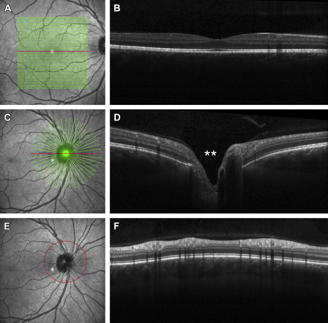 Optical Coherence Tomography for the Radiologist Radiology Key