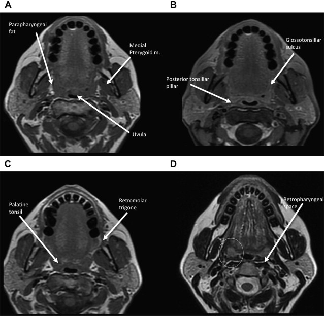 Pitfalls in the Staging of Cancer of the Oropharyngeal Squamous Cell