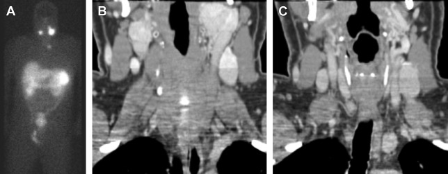 Paragangliomas of the Head and Neck Radiology Key