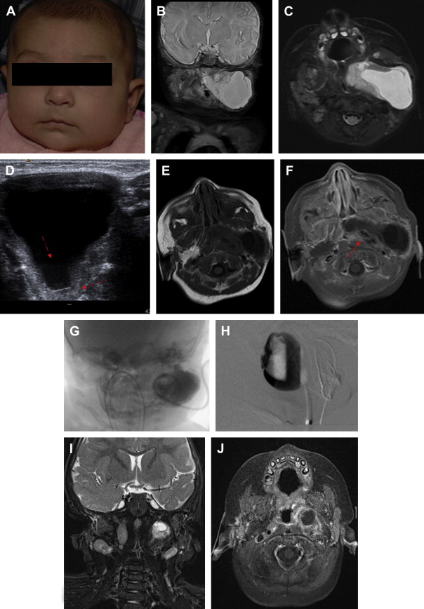 Neurointerventional Management of LowFlow Vascular Malformations of