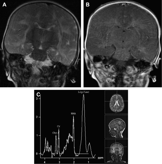 Central Nervous System Infections of Herpesvirus Family Radiology Key