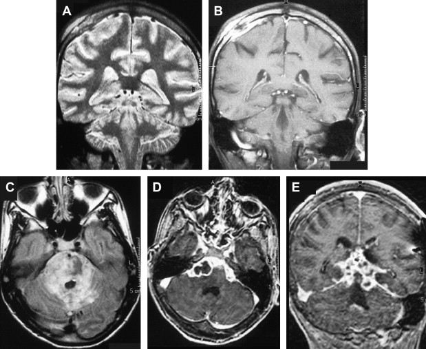 Neuroimaging in the Brain in HIV1Infected Patients Radiology Key