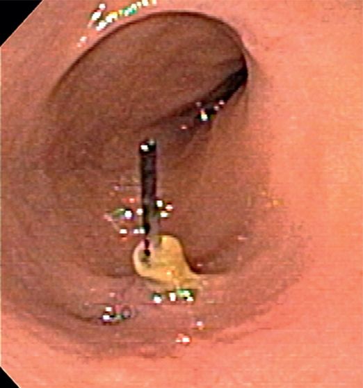 Vascular interventions | Radiology Key