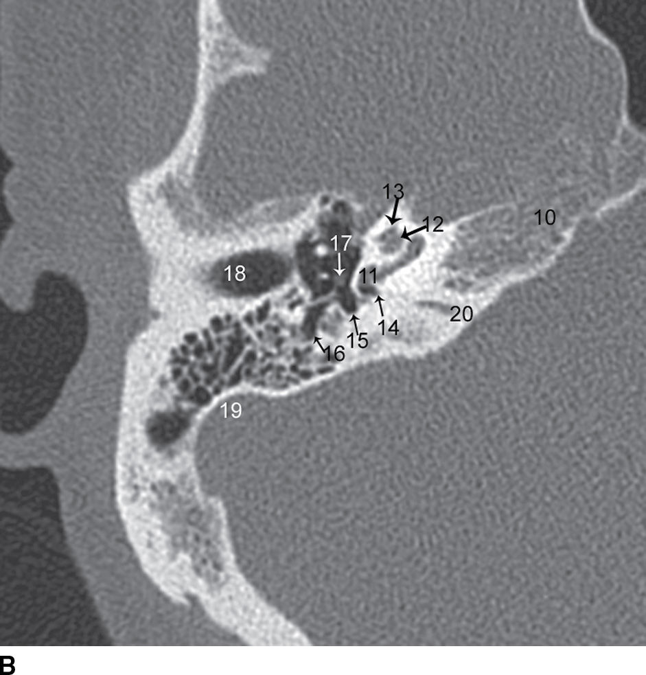 Temporal Bone Imaging Radiology Key