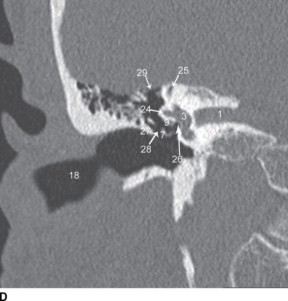 Temporal Bone Imaging Radiology Key