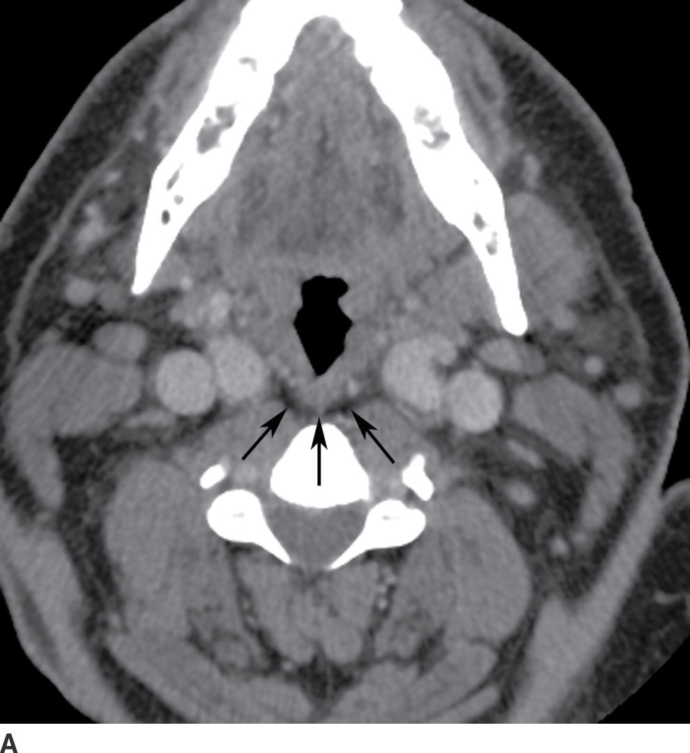 The Acute Neck Inflammation, Infections, and Trauma Radiology Key