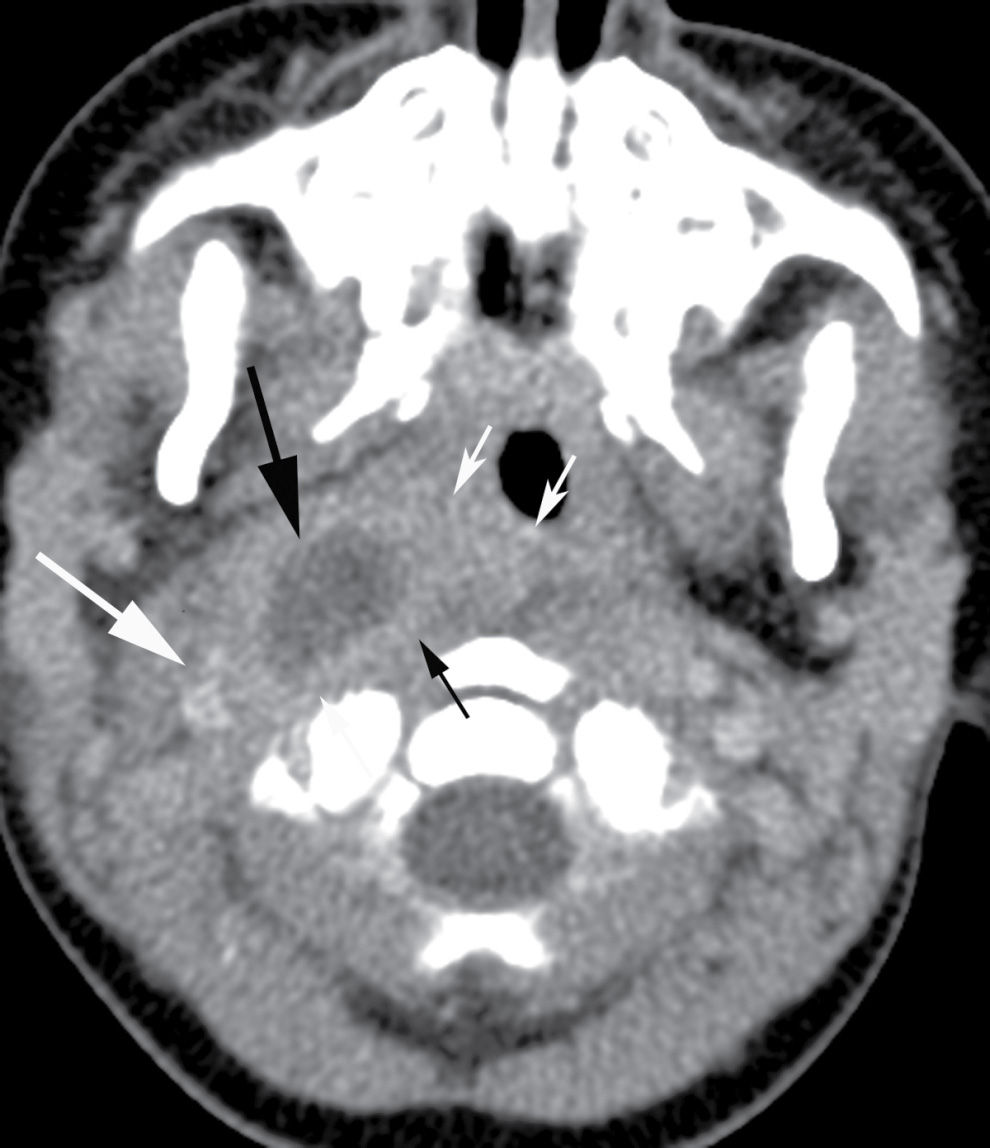The Acute Neck Inflammation, Infections, and Trauma Radiology Key