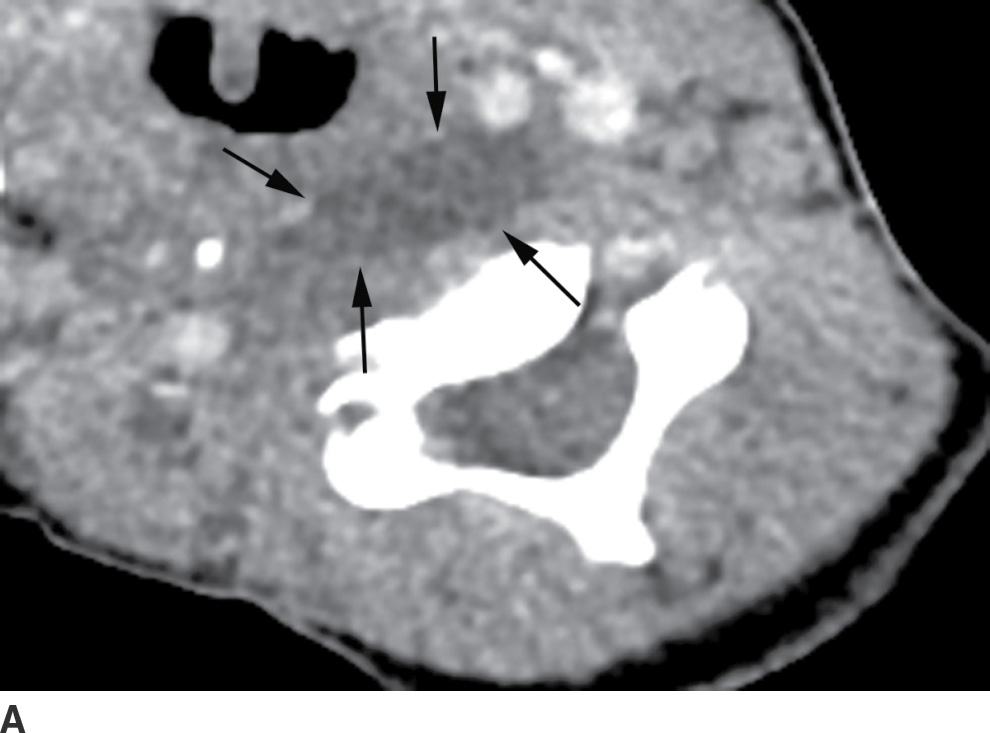 The Acute Neck Inflammation, Infections, and Trauma Radiology Key