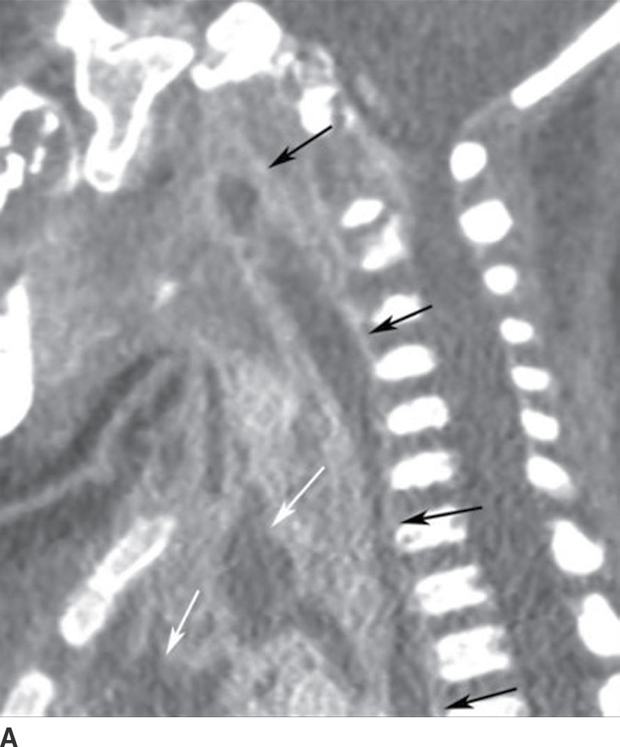 The Acute Neck Inflammation, Infections, and Trauma Radiology Key