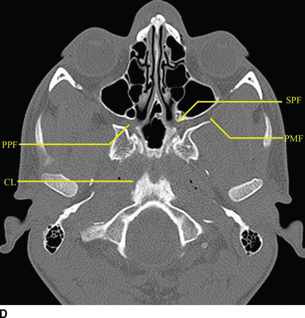Ventral and Central Skull Base Sinonasal, Sellar, Parasellar, and
