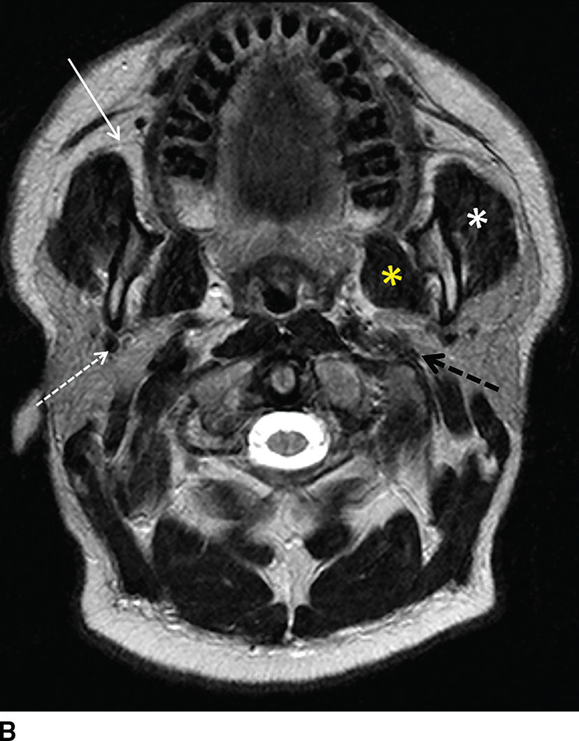 The Glands Salivary, Thyroid, and Parathyroid Imaging Radiology Key