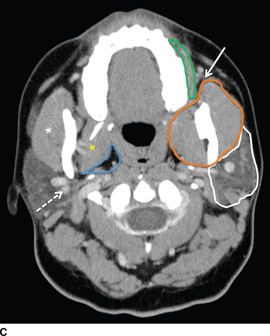Parotid Gland Anatomy Ct Images and Photos finder