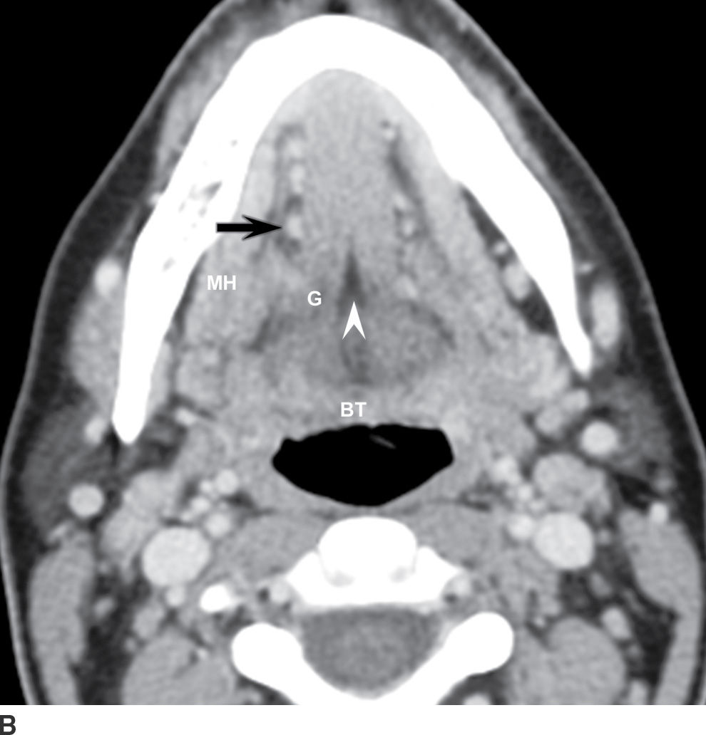 Mucosal Cancers Neck Primaries and the Lymph Nodes Radiology Key