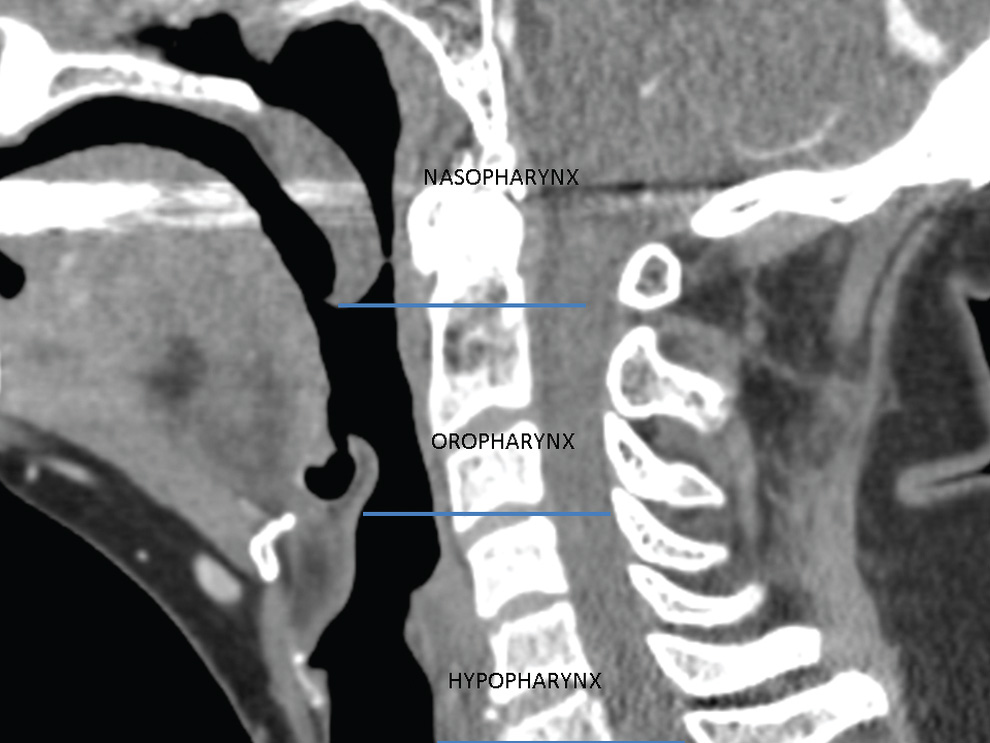 Mucosal Cancers Neck Primaries and the Lymph Nodes Radiology Key