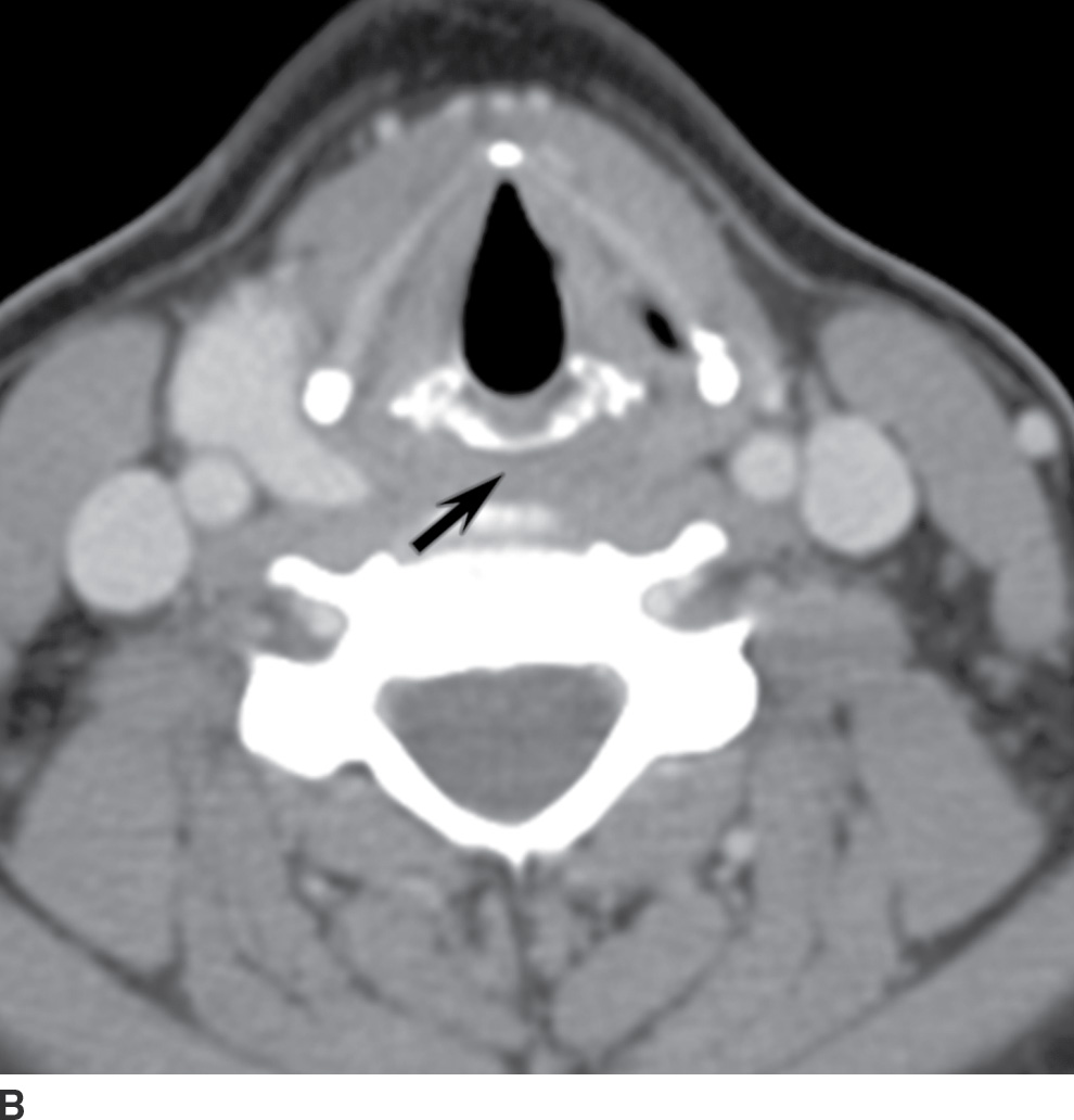 Mucosal Cancers Neck Primaries and the Lymph Nodes Radiology Key