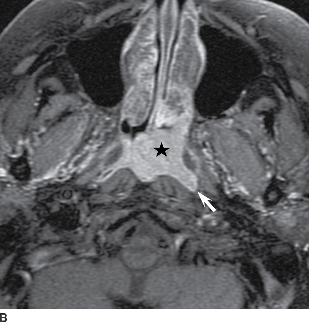 Mucosal Cancers Neck Primaries and the Lymph Nodes Radiology Key