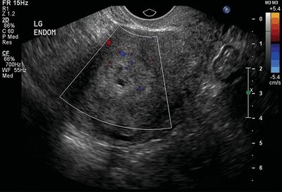 A pelvic ultrasound allows quick visualization of the female pelvic organs and structures including the uterus, cervix, vagina, fallopian tubes and ovaries. Female Genital I Uterus And Cervix Radiology Key