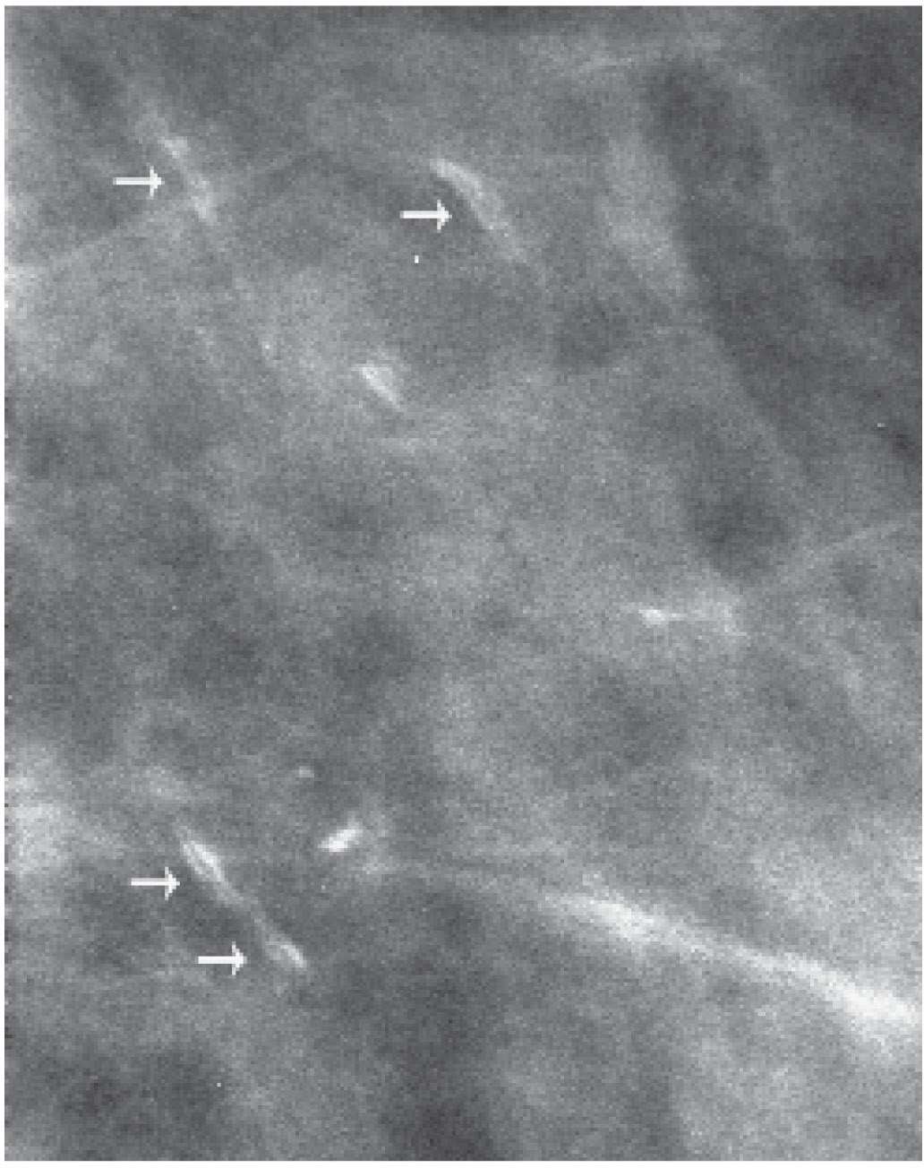 Breast Calcifications Radiology Key