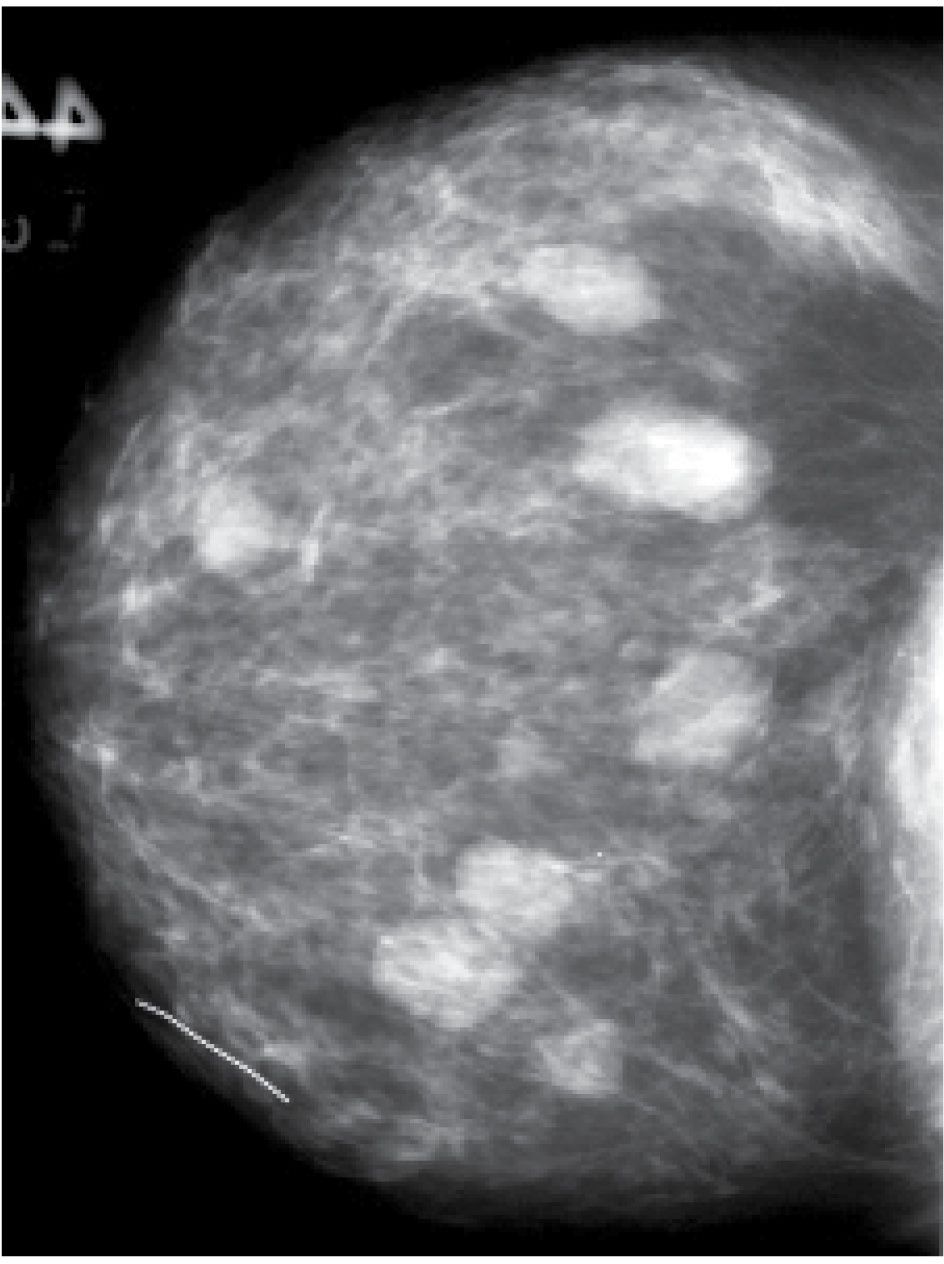 Evaluation and Imaging Features of Benign Breast Masses Radiology Key