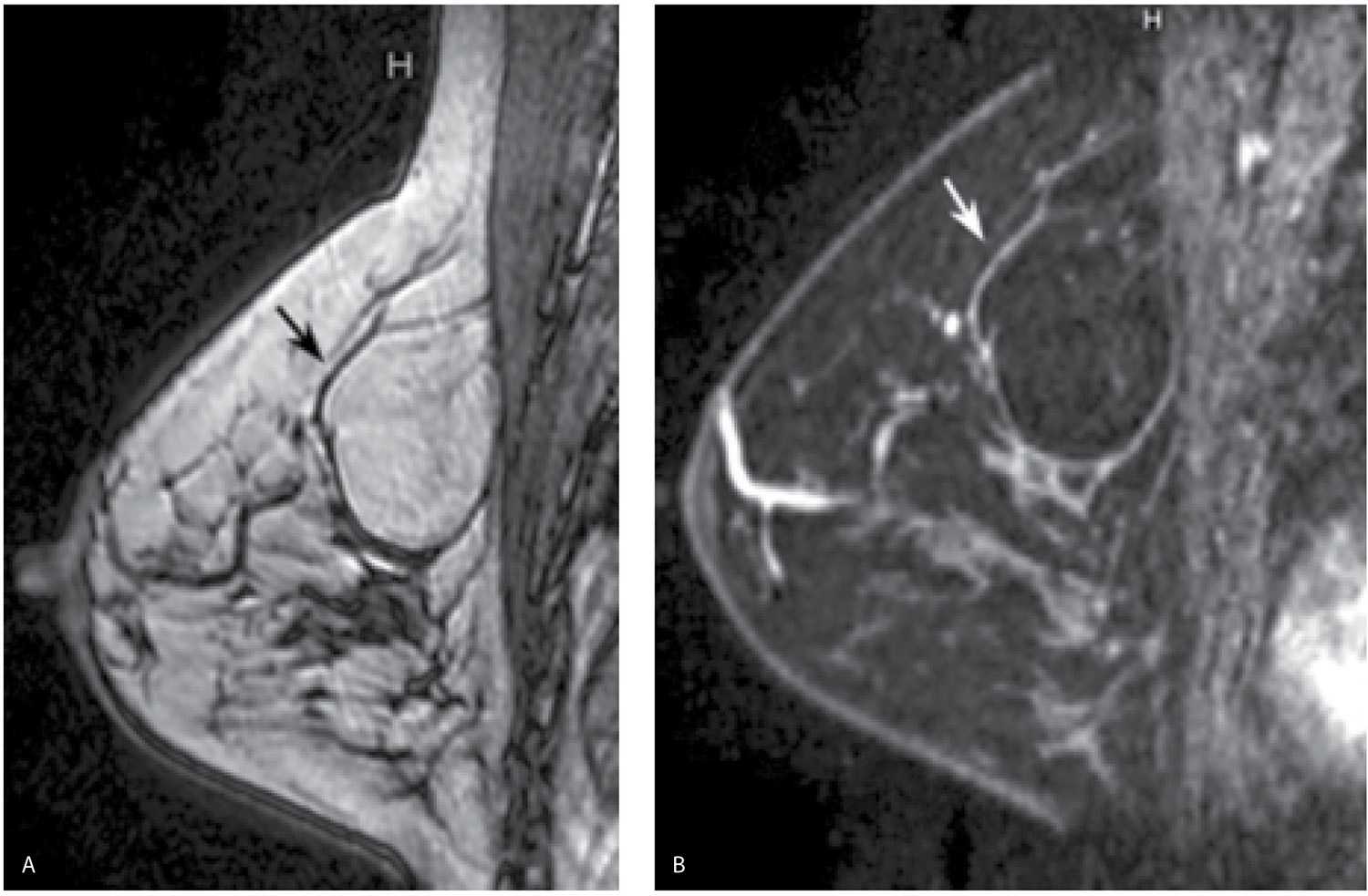 Evaluation and Imaging Features of Benign Breast Masses Radiology Key