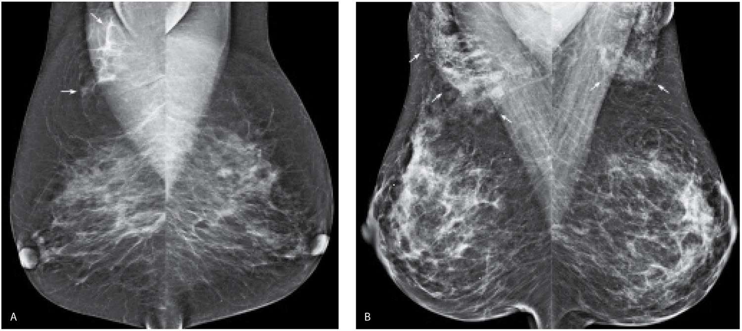Miscellaneous Mammographic Findings Radiology Key