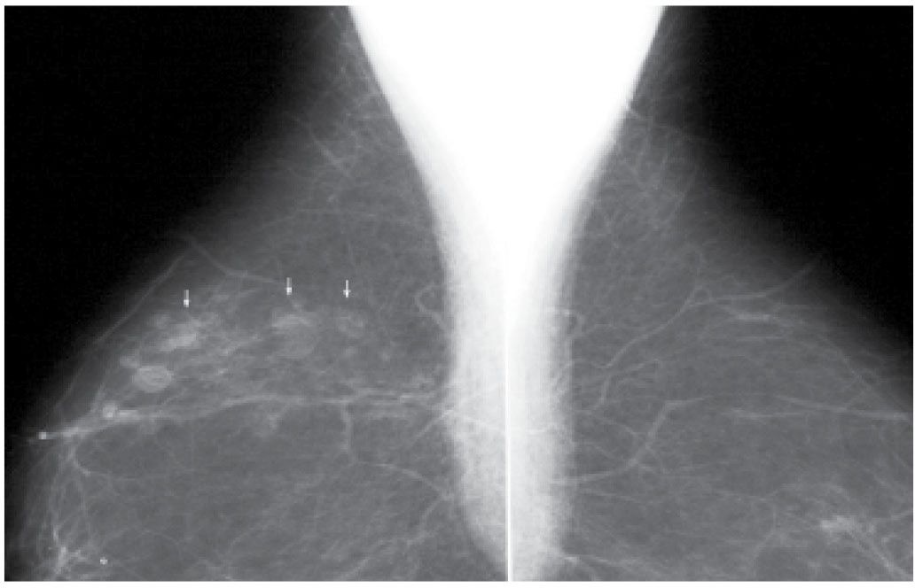 The Altered Breast Radiology Key