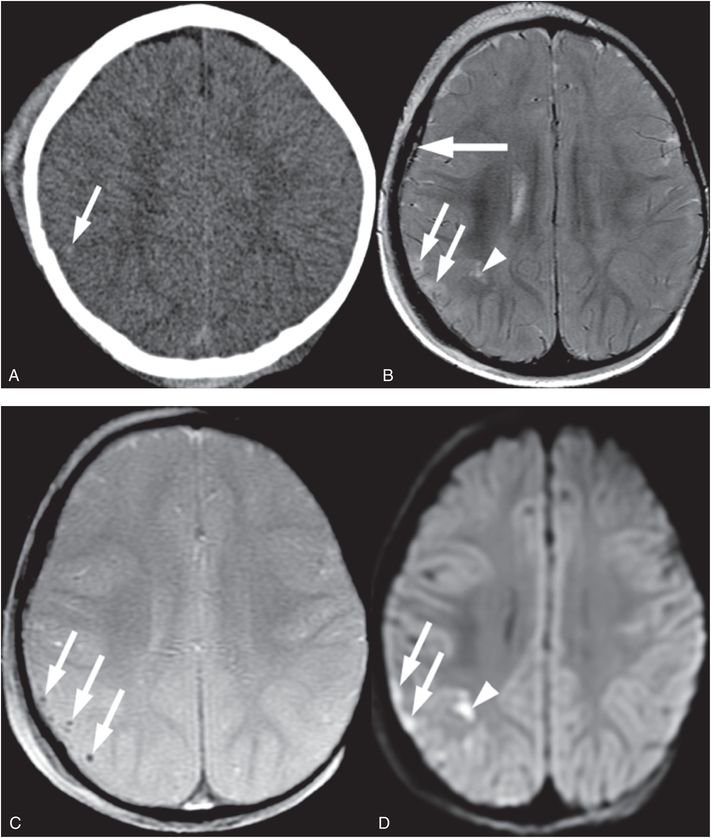 Abusive head trauma parenchymal injury Radiology Key