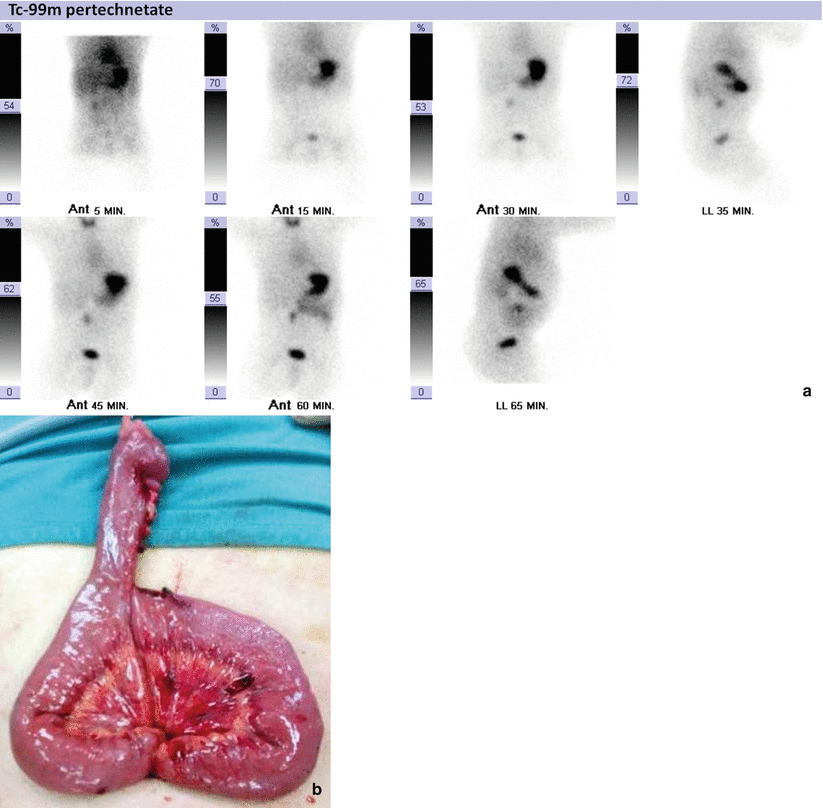 Gastroenterology Intestinal Bleeding Radiology Key