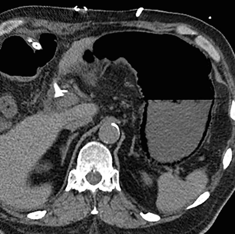 Stomach | Radiology Key