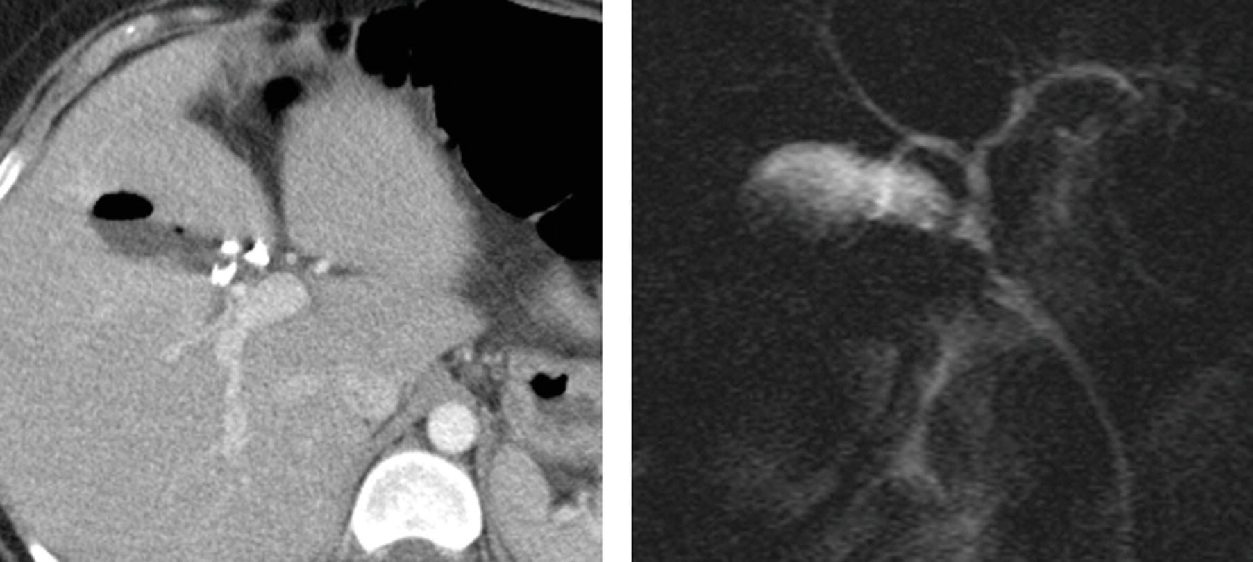 Bile Ducts and Gallbladder Radiology Key