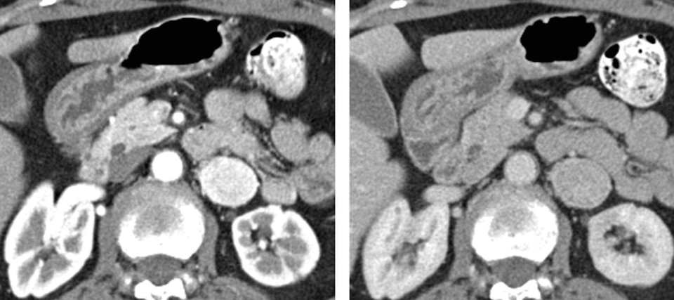 Back pain is one of the most common reasons people visit a doctor. Peritoneum and Retroperitoneum | Radiology Key