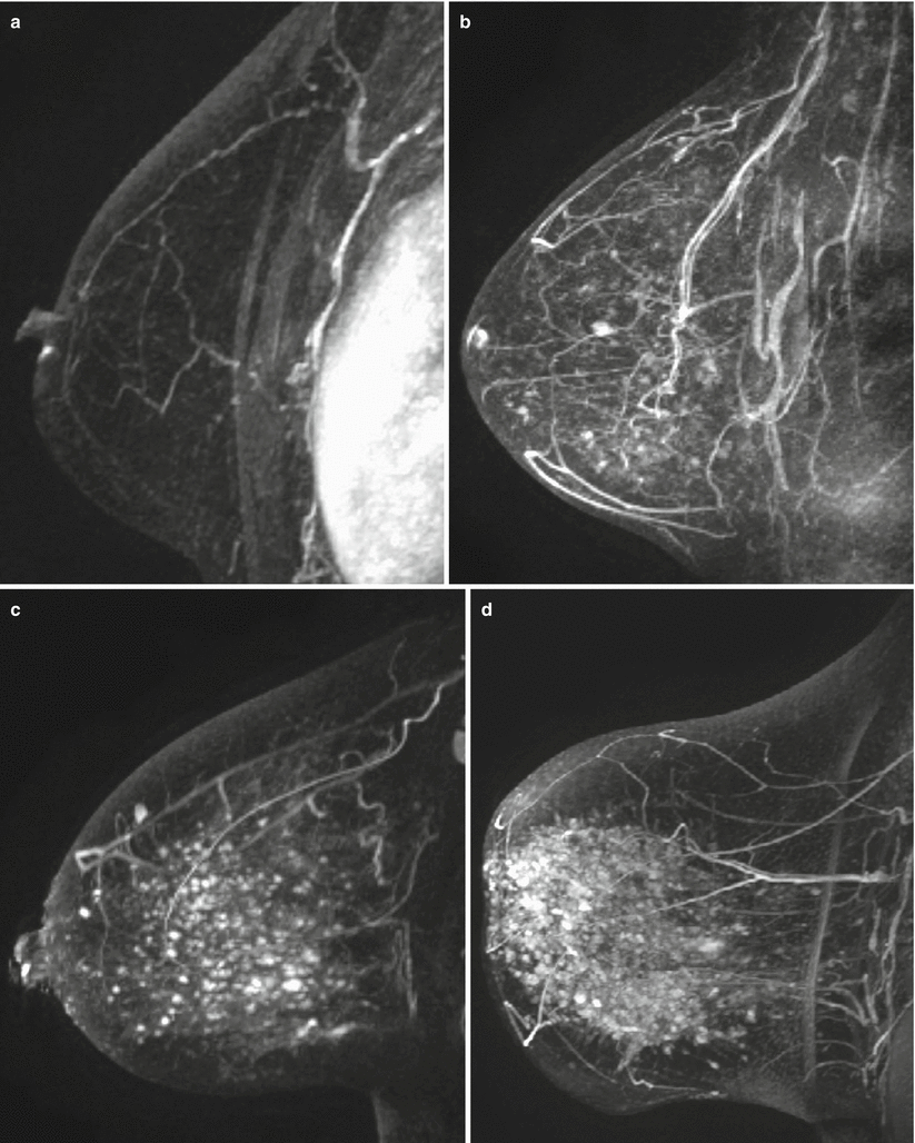 Breast MRI Basics Radiology Key