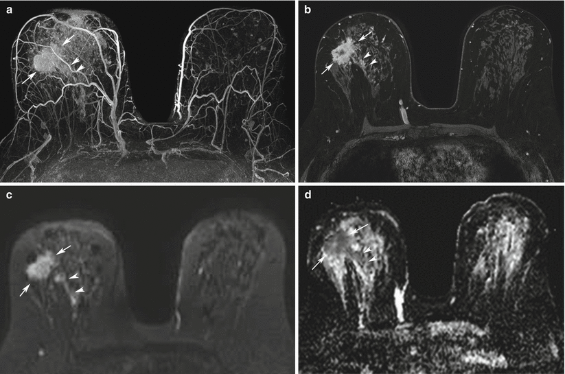 Breast MRI Basics Radiology Key