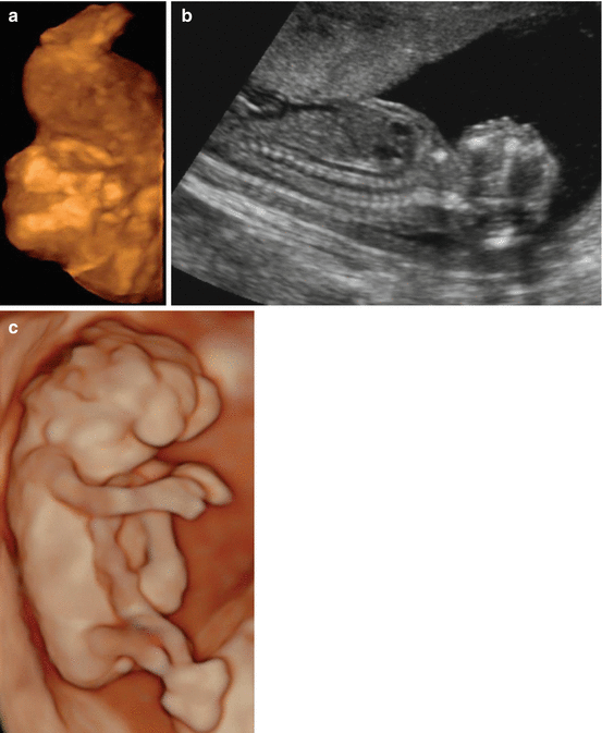 FirstTrimester Pathologies Radiology Key