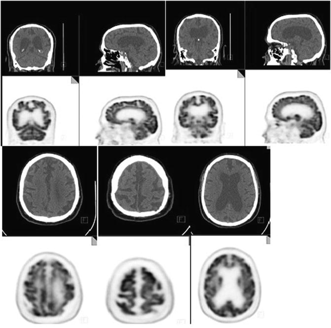 Dementia Radiology Key