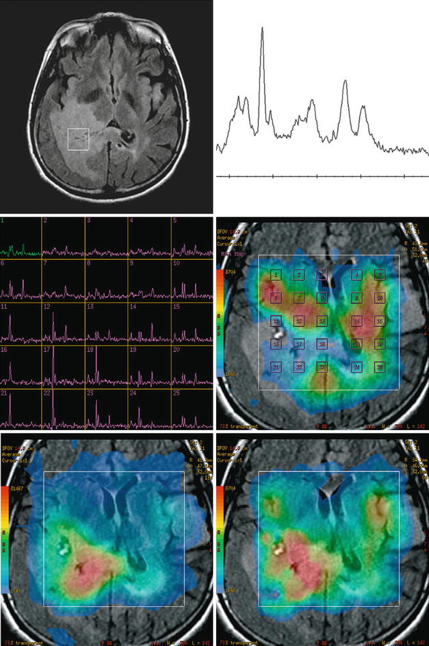3.0 T MR Spectroscopy Radiology Key