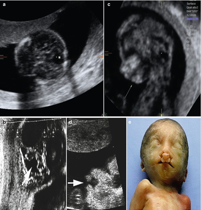 Micrognathia Radiology Key