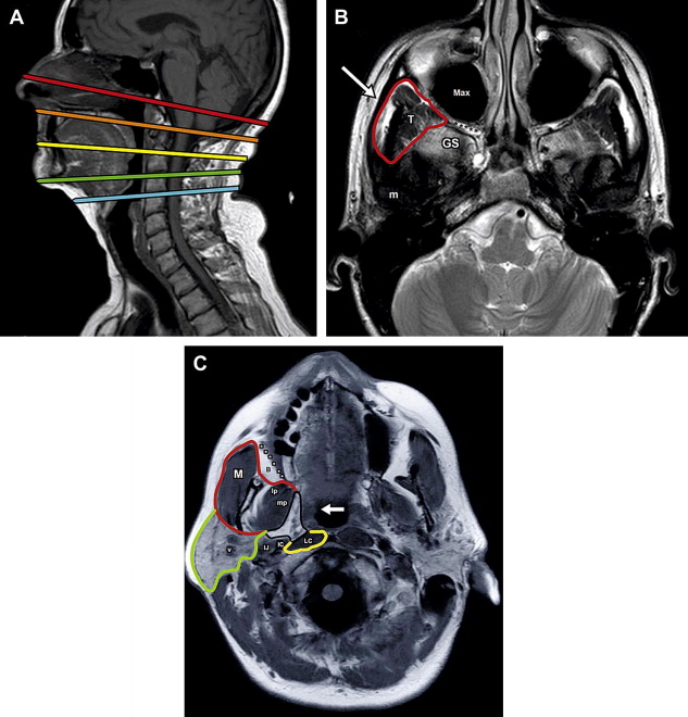 Neck MR Imaging Anatomy Radiology Key