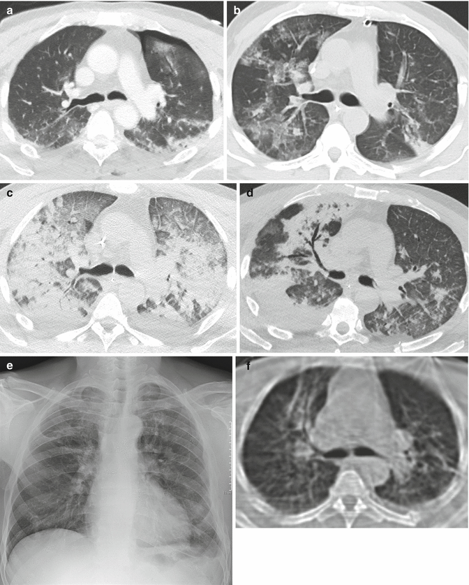 Parenchymal Lung Disease Radiology Key