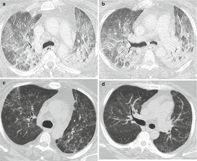 Parenchymal Lung Disease Radiology Key