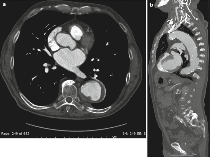 Aortic Aneurysms, Fistula, and Thrombus Radiology Key