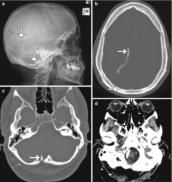 Imaging of Cerebrospinal Fluid Shunts, Drains, and Diversion Techniques