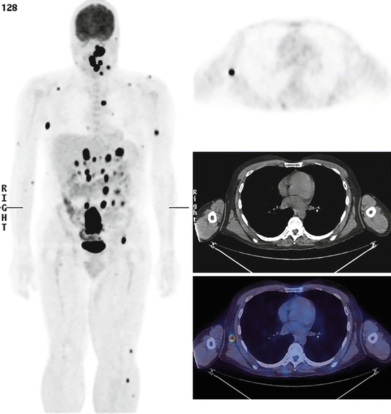 Role of PET/CT in Melanoma Radiology Key