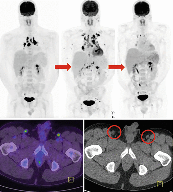 Role of PET/CT in Melanoma Radiology Key